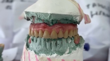 “Pehua Sonríe”: el programa municipal lleva casi mil prótesis dentales entregadas