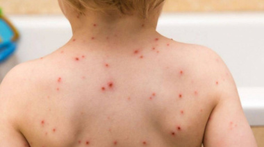 Un brote de sarampión enciende alarmas en la Provincia