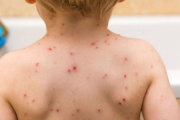 Un brote de sarampión enciende alarmas en la Provincia